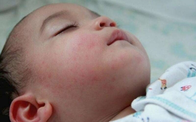 Cách phân biệt giữa sởi và phát ban để chăm bé đúng cách